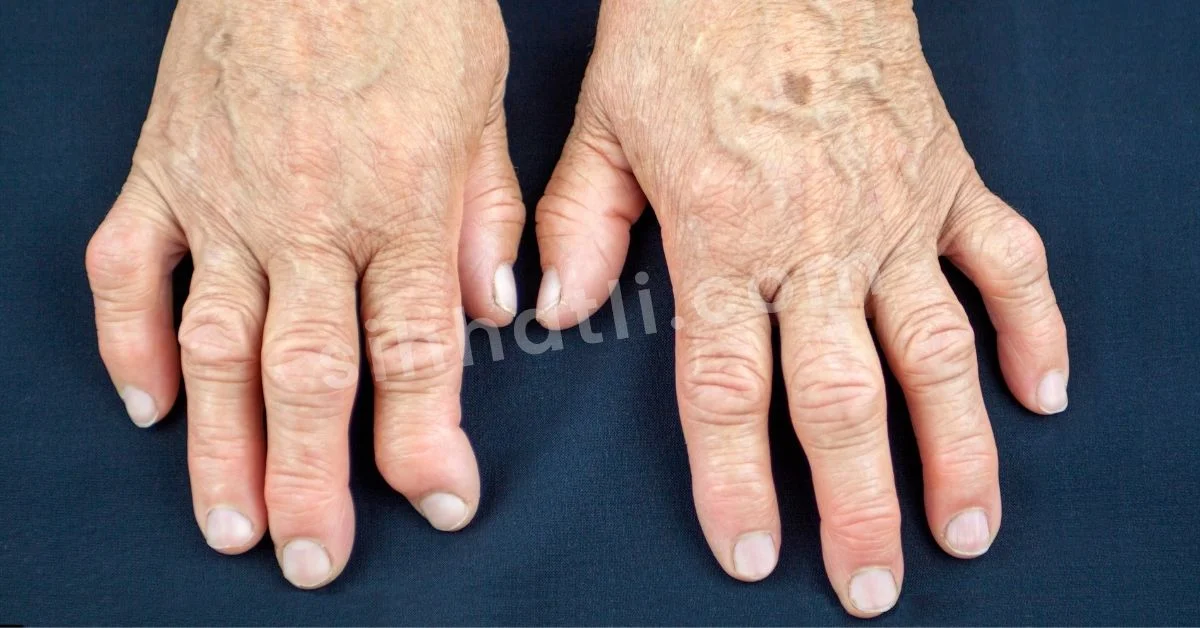 Romatoid Artrit Nedir
